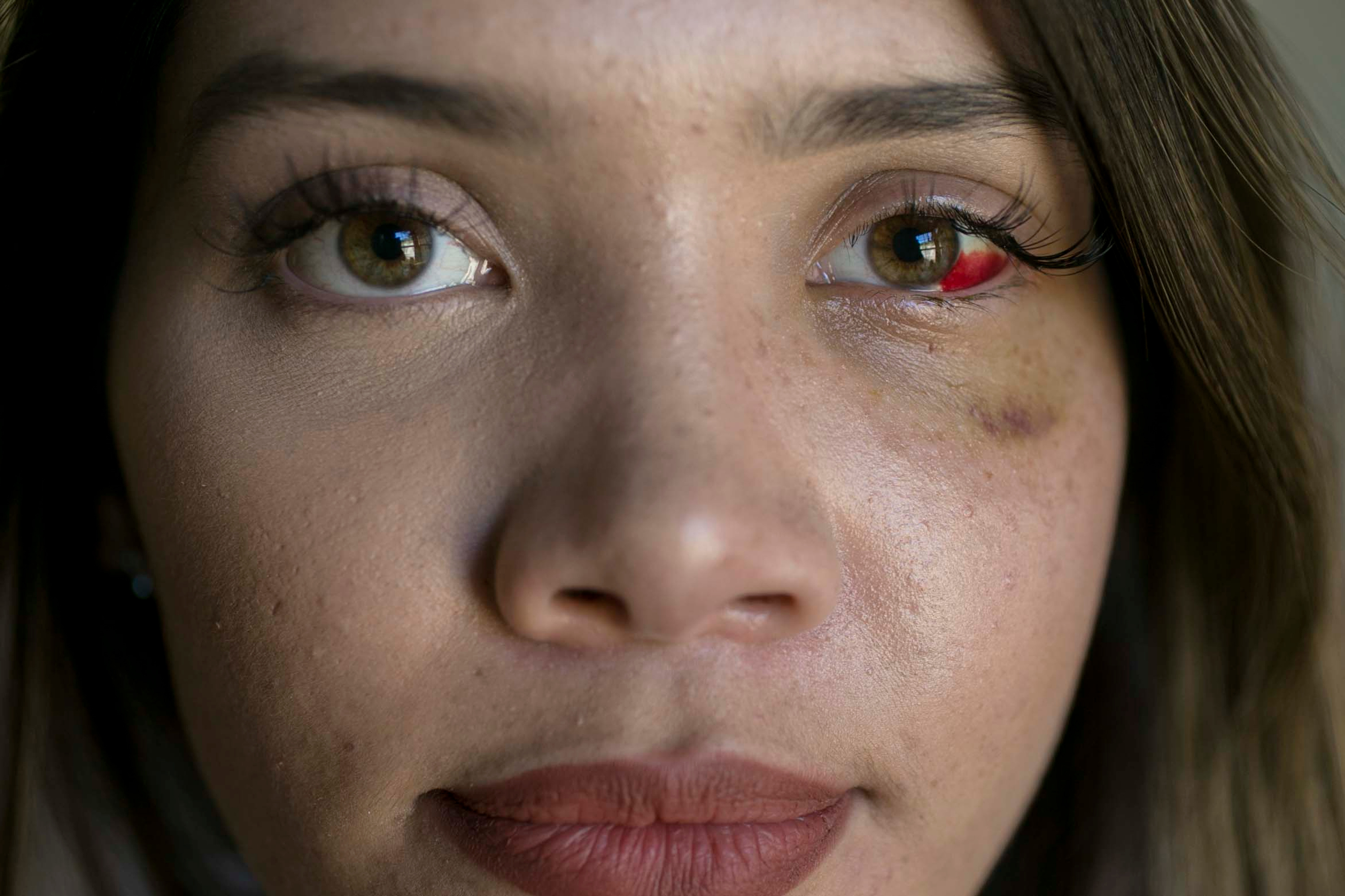 A portrait shot of a woman's face who has blood in one of her eyes.