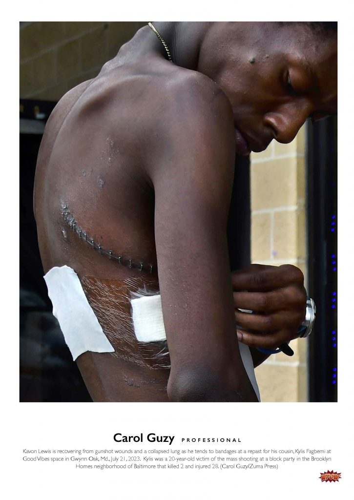 Photograph of a person attending to a bandaged wound on his side. Person has scars from treatment for gunshot wounds.